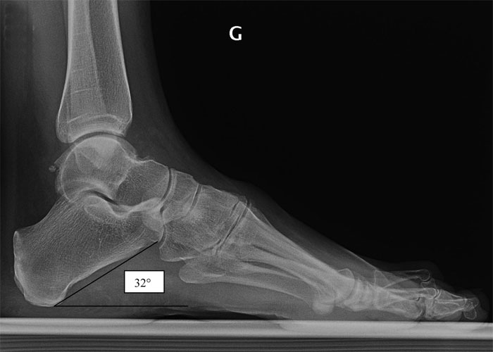imagerie_pathologie_arriere_pied PIED CREUX — free download